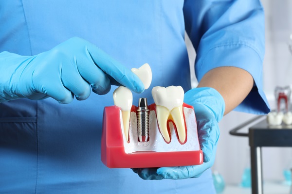 Dental Implant Restoration Hanford, CA