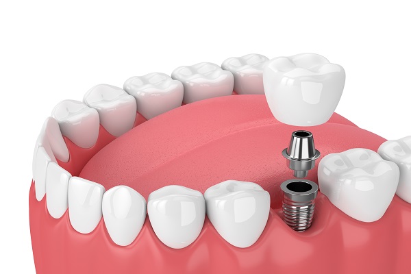 Dental Implants Hanford, CA