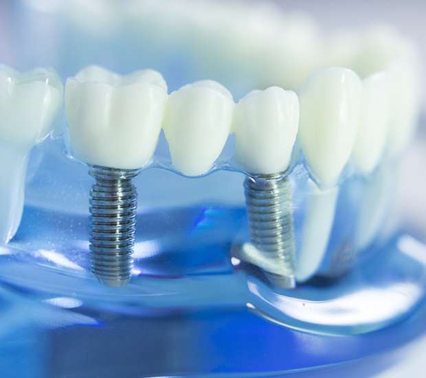 Hanford Dental Implants