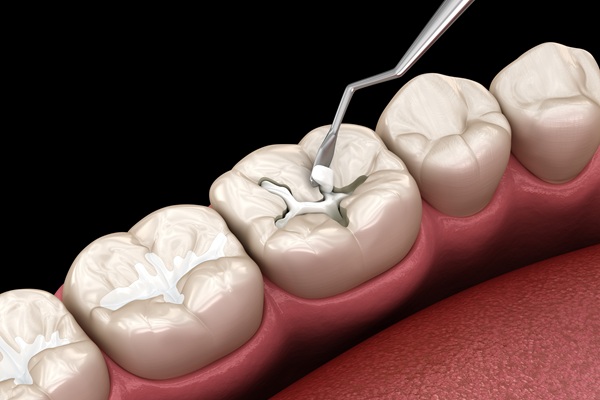 How Long Will A Dental Inlay Last?