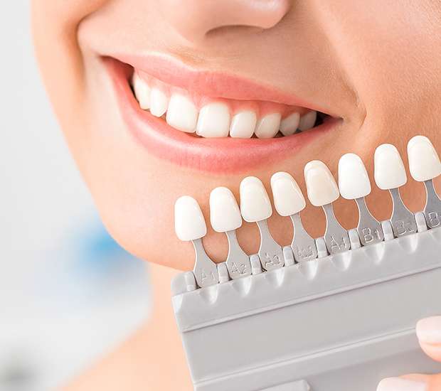 Hanford Veneers