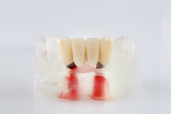 Recovery Tips After An Implant Supported Dentures Procedure